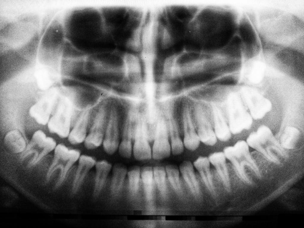 rendgenska snimka zubiju